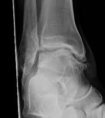 Chronic ankle instability X-ray diagnosis