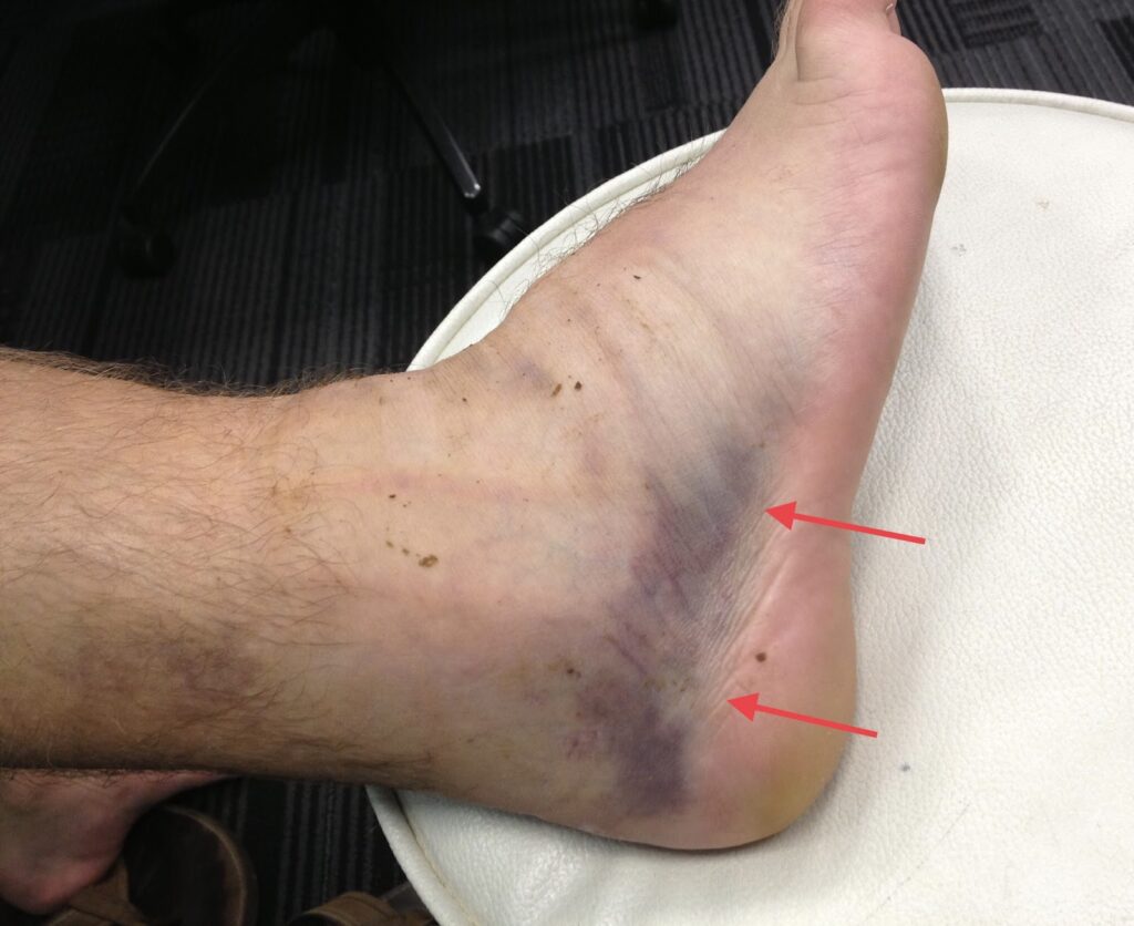 Chronic ankle instability