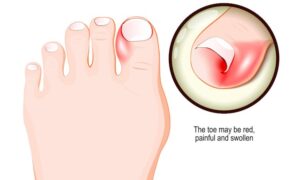 Ingrown Toenail