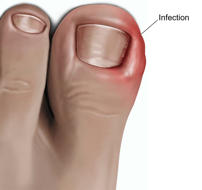 Ingrown Toenails