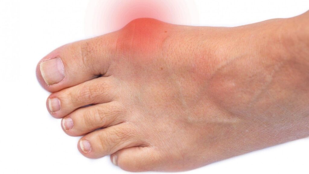 Bunions